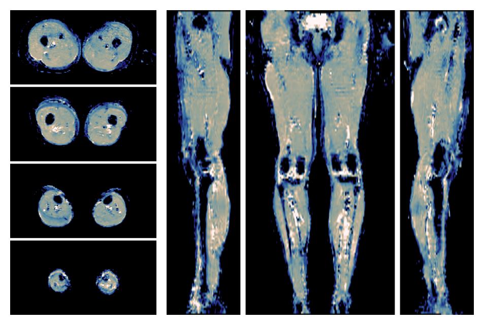 IVIM corrected whole leg muscle mean diffusivity obtained from diffusion tensor imaging.
